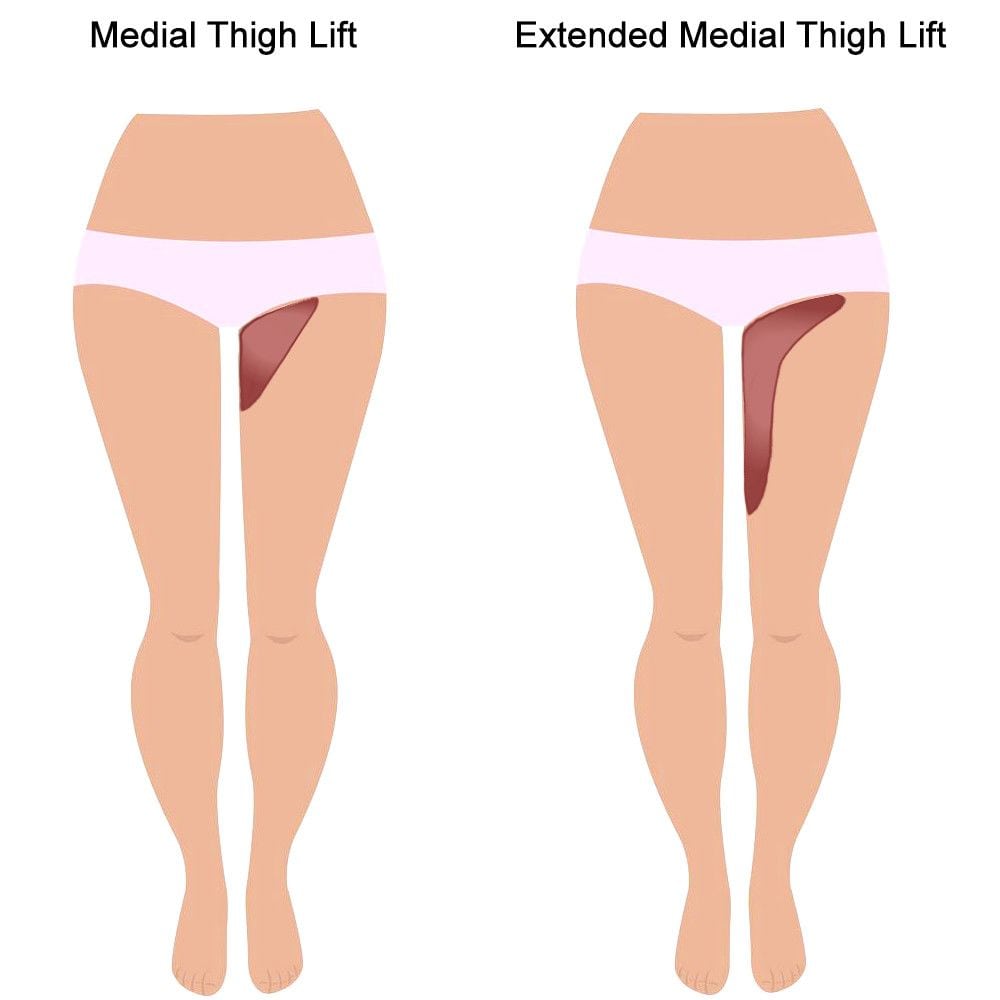 Liposuction or Tummy Tuck – Which Is Best for You?