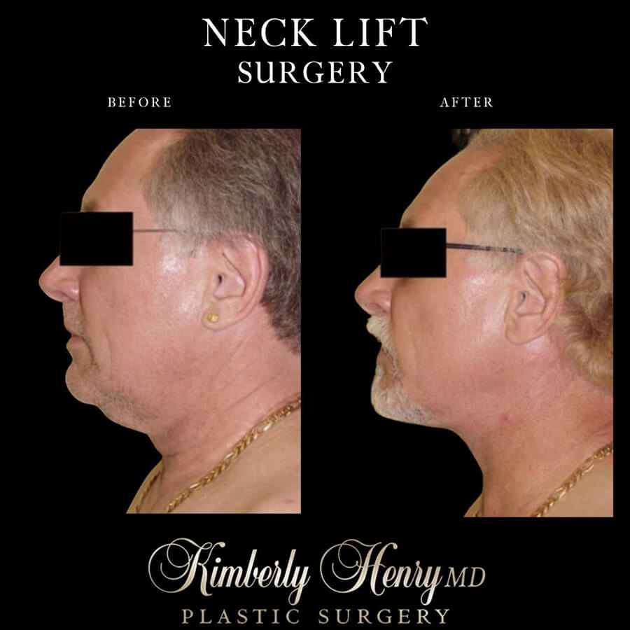 Neck Surgery Before and after results