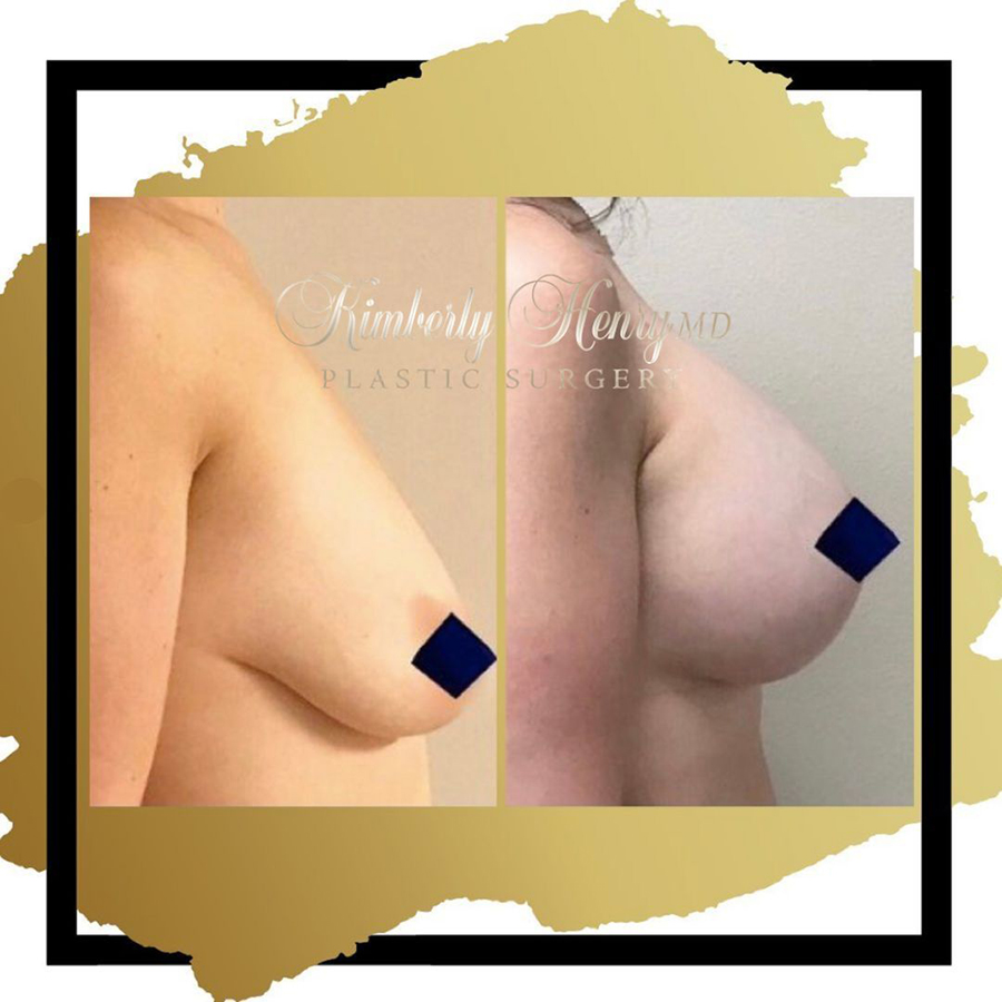 Before and after breast results